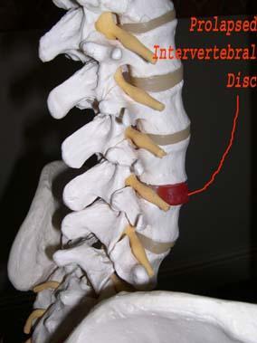 Osteopathy - Sciatica